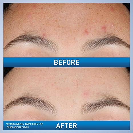 CeraVe Resurfacing Retinol Serum – Post-Acne Marks & Pore Minimizer