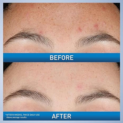 CeraVe Resurfacing Retinol Serum – Post-Acne Marks & Pore Minimizer