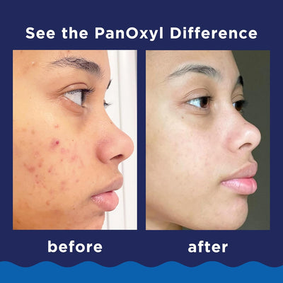 PanOxyl Acne Foaming Wash 10% Benzoyl Peroxide Maximum Strength
